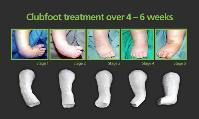 Club Foot Dr Rajesh Simon Orthopaedic Surgeon Foot N Ankle Kochi Kelala 4579